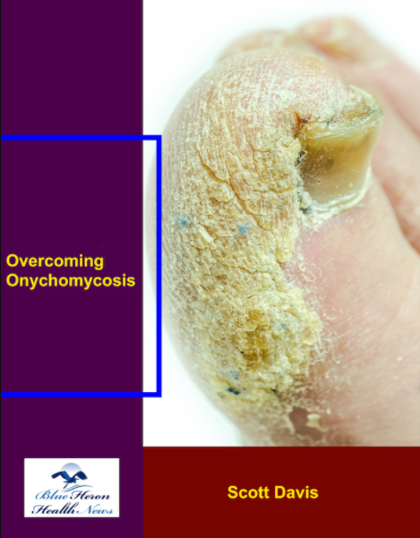 Overcoming Onychomycosis Reviews