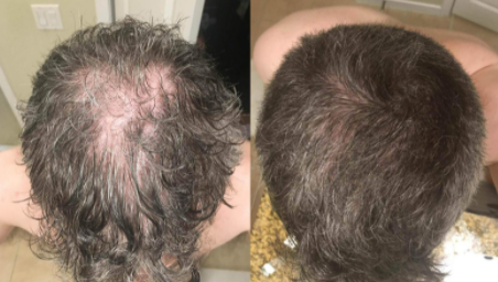 Folicrex Hair Loss Supplement