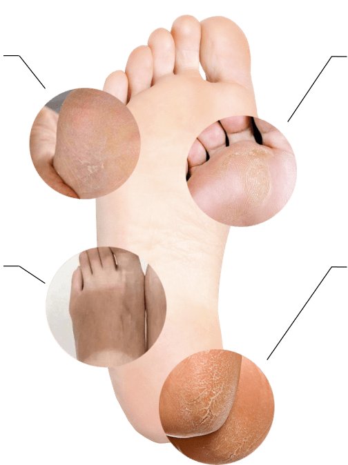 Melzu Foot Peel Mask Where to Buy