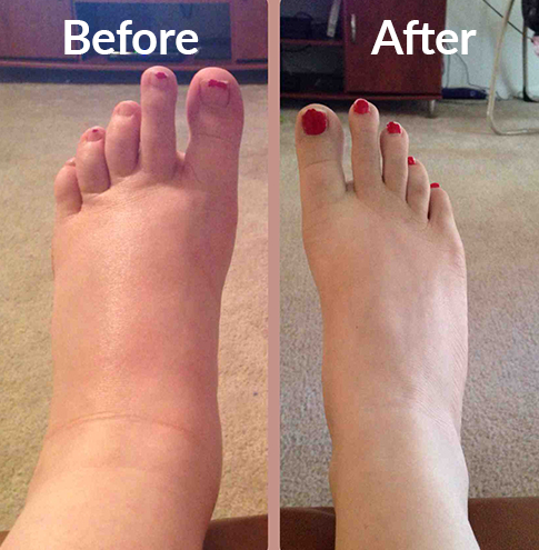 Pain Hero Compression Socks Before & After Results
