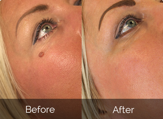 Silky Skin Tag Remover Before & After Results