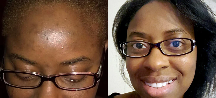 Civant Meladerm Before & After Results