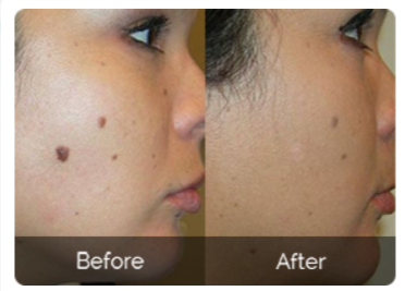 Remedy Skin Tag Remover Before & After Results
