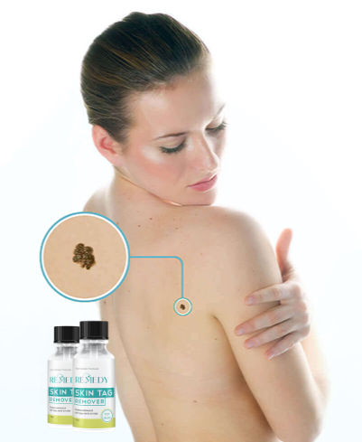 Remedy Skin Tag Remover Customer Reviews