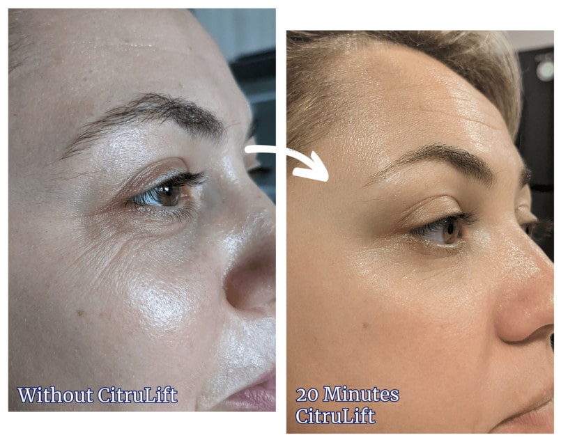 Restore Skin Labs CitruLift Before & After Results