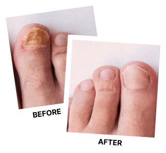 Nature's Remedy Fungus Remover Before & After Results