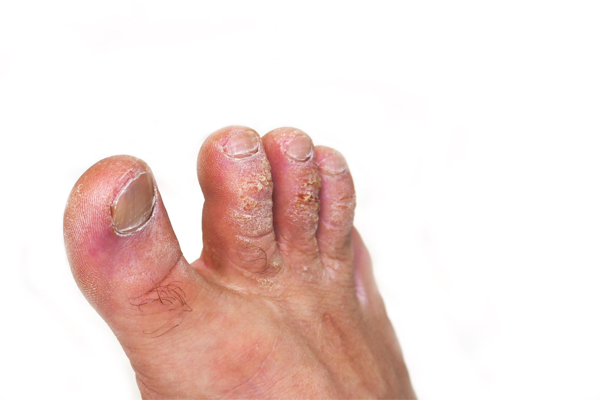 3-Minute Shower Hack to Cure Toenail Fungus