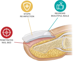 EmoniNail benefits