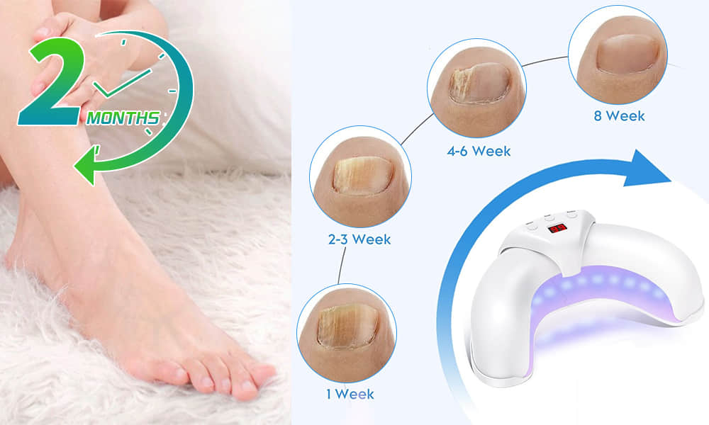 Laser Therapy Device for Nail Fungus at Home
