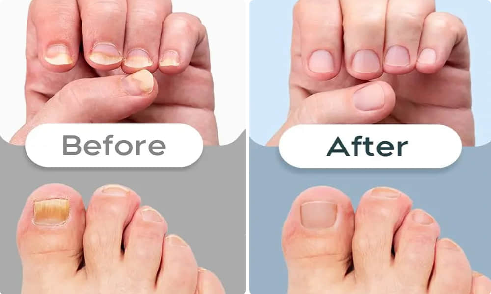 Nail Fungus before and after