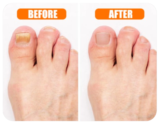 Toenail Fungus before & after