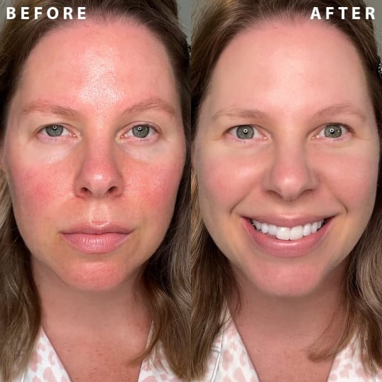 Skin IL Makiage Before & After